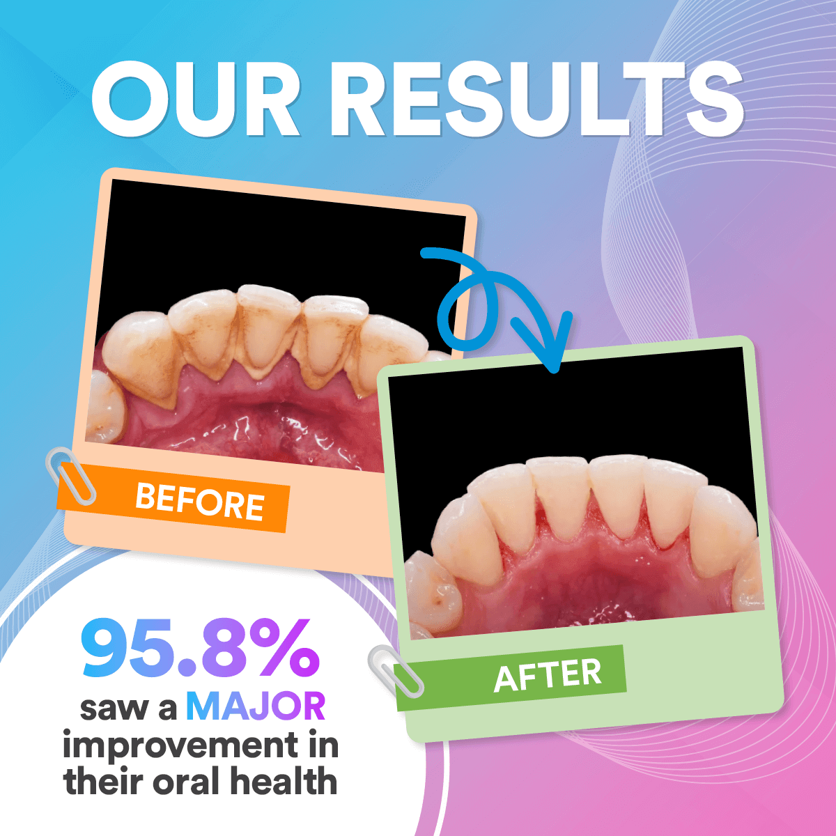 Efficient Water Flosser: Portable Oral Irrigator, Long Battery Life, 3 Pressure Settings, Ideal for Braces & Gum Care DP7