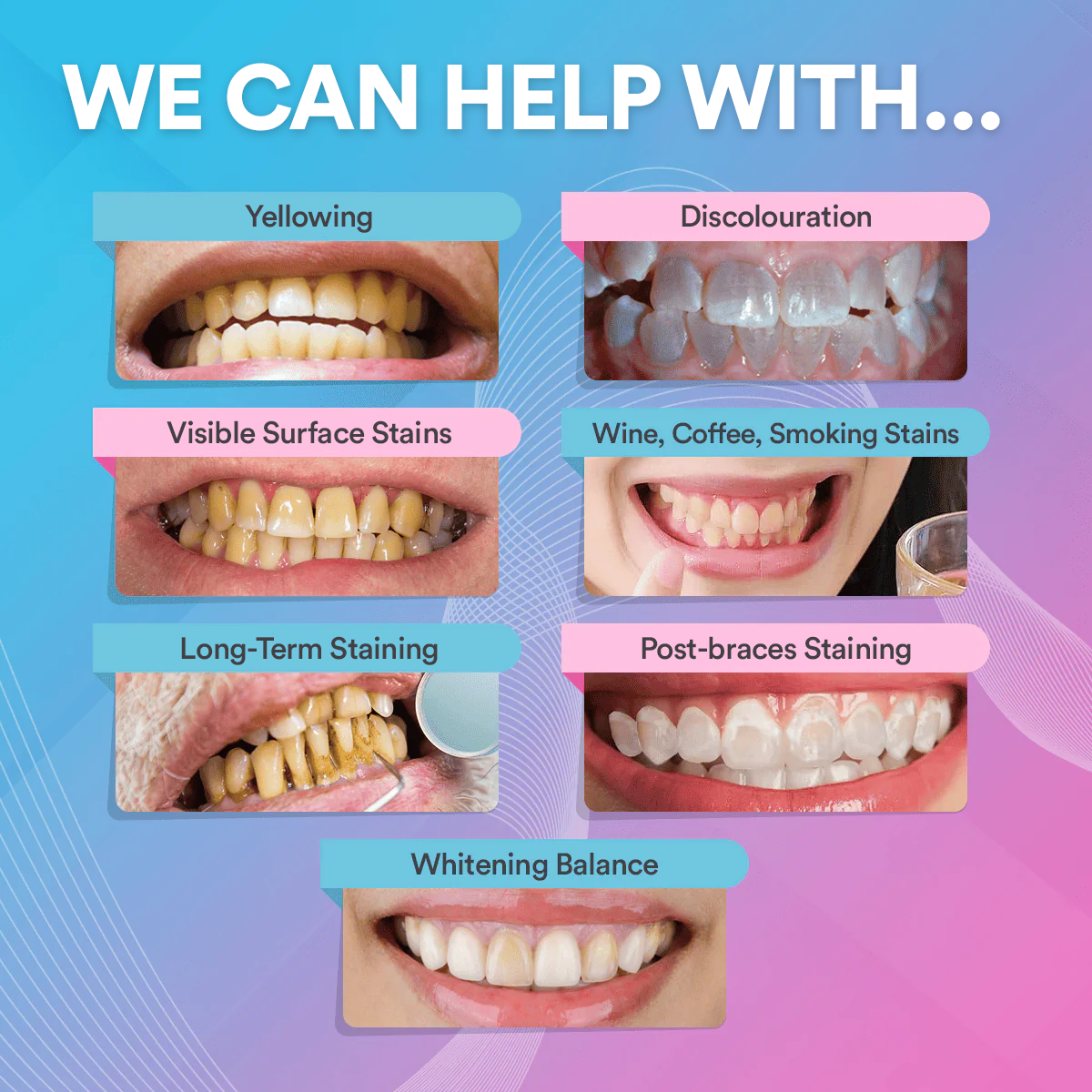 Teeth Whitening Strips At Home