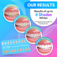 Teeth Whitening Kit